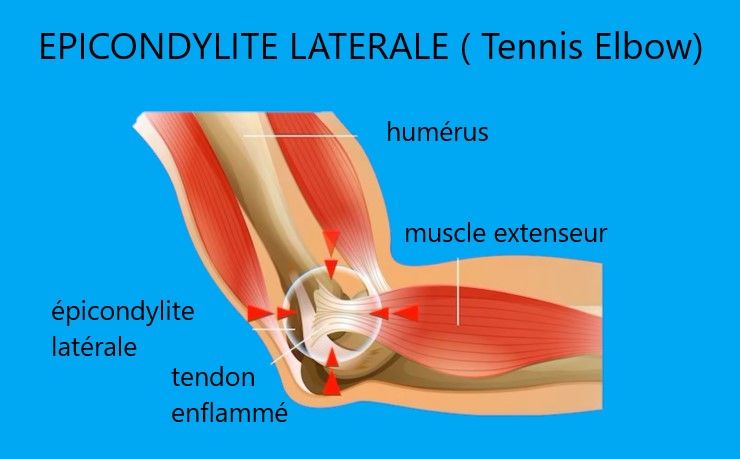 schéma d'une tendinite au coude appelé tennis elbow ou épicondylite latérale