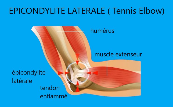 Tendinopathies Les 10 Tendinites Les Plus Courantes